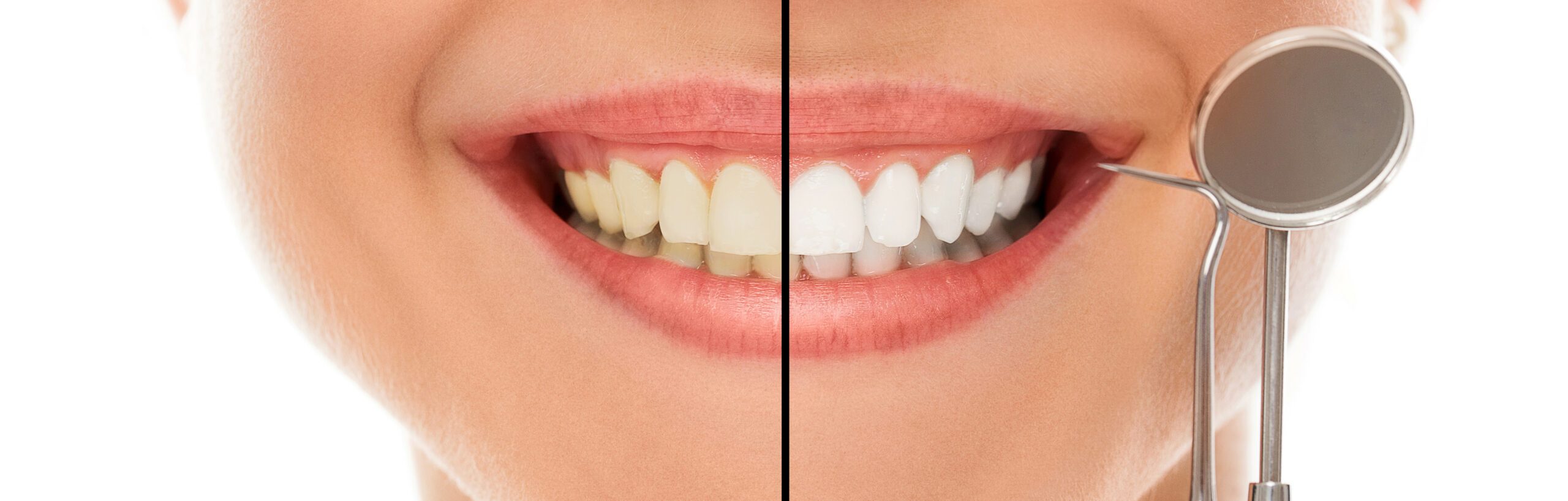 sonrisa mostrando dientes con blanqueamiento y sin