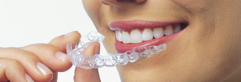 mujer sonriendo con una férula de invisalign en la boca